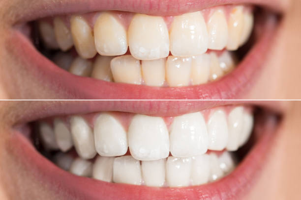 Teeth whitening
